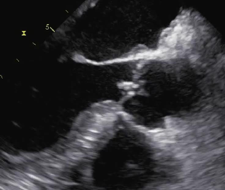 Vegetazioni aortiche