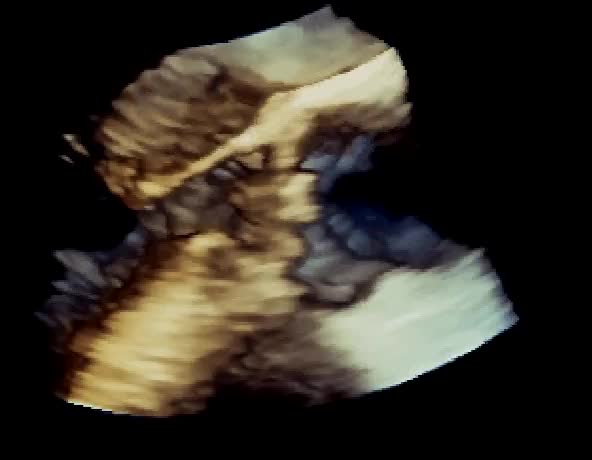 Vegetazioni aortiche