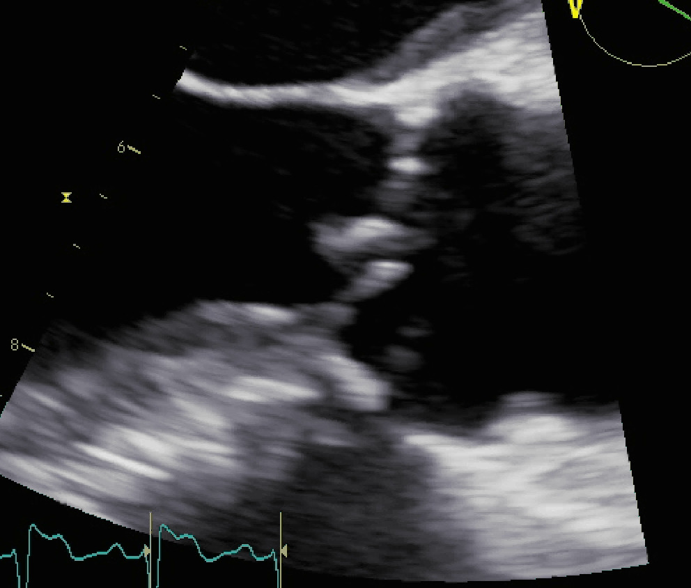 Vegetazioni aortiche