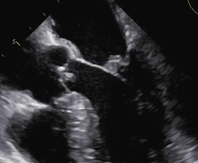 Vegetazioni aortiche e mitraliche