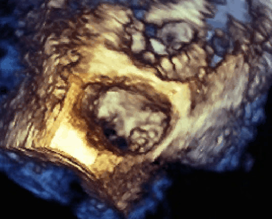 Vegetazioni aortiche e mitraliche