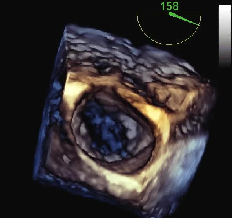 Vegetazioni aortiche e mitraliche