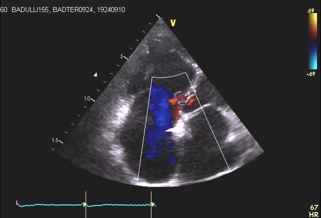Insufficienza tricuspidale severa
