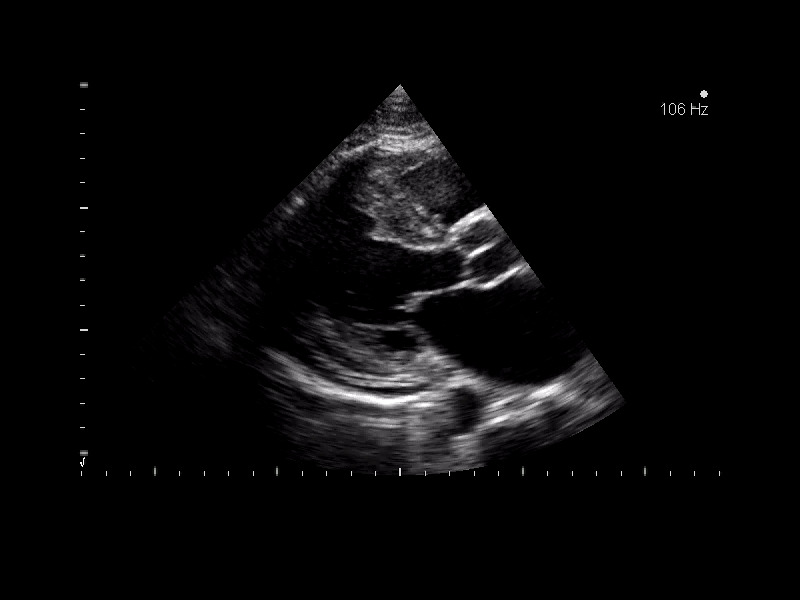 Malattia di Anderson-Fabry