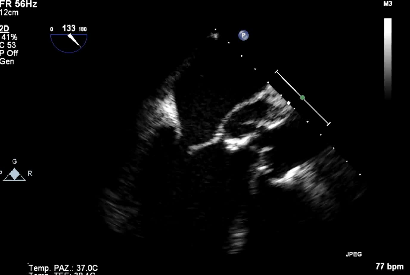 Pseudoaneurisma periprotesico