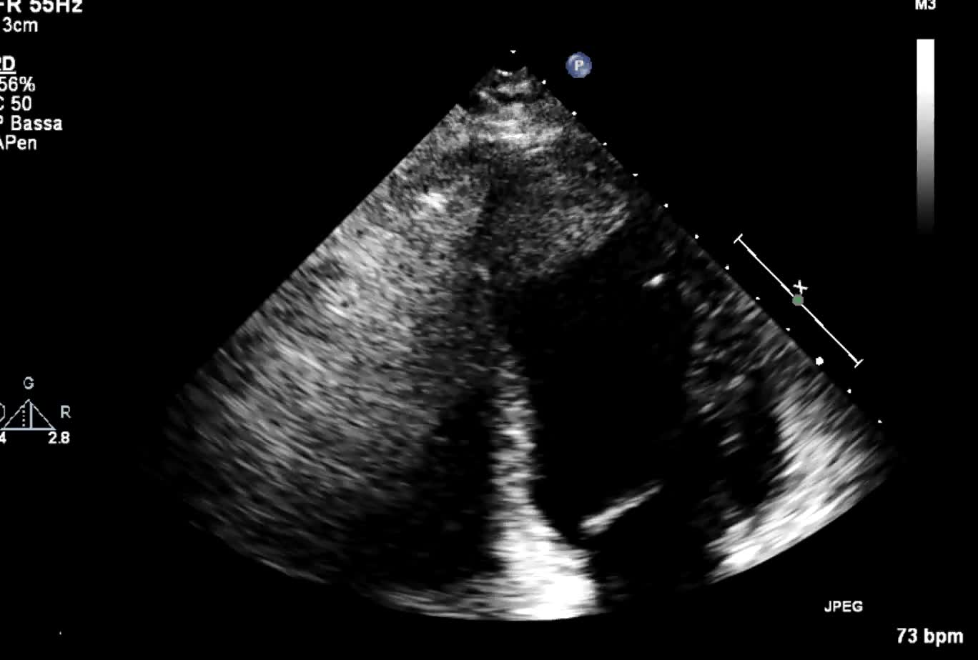 Trombo endoventricolare