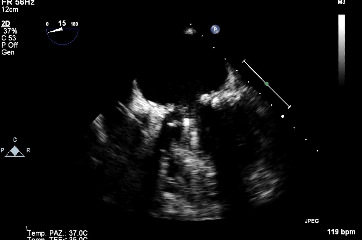 Trombo endoventricolare