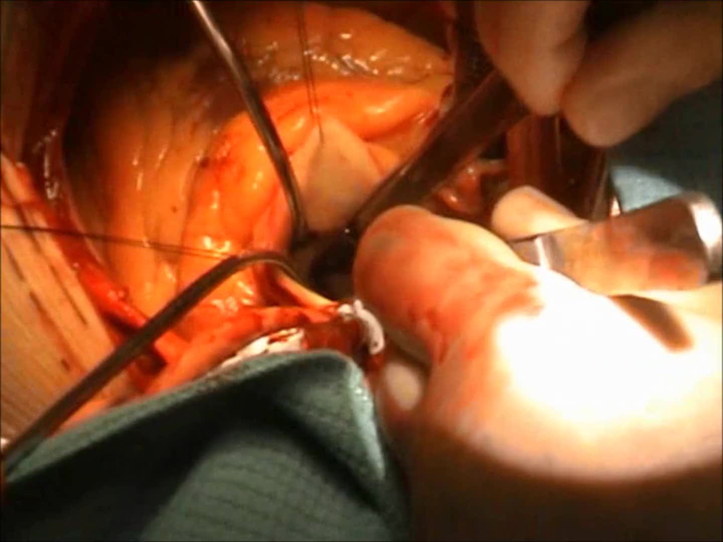 Miectomia settale estesa sec morrow