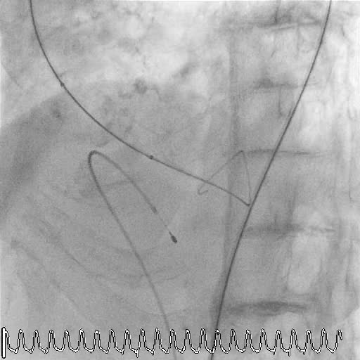 Valvuloplastica aortica