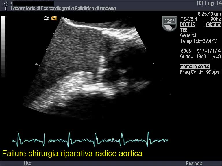 Failure di chirurgia riparativa della radice aortica