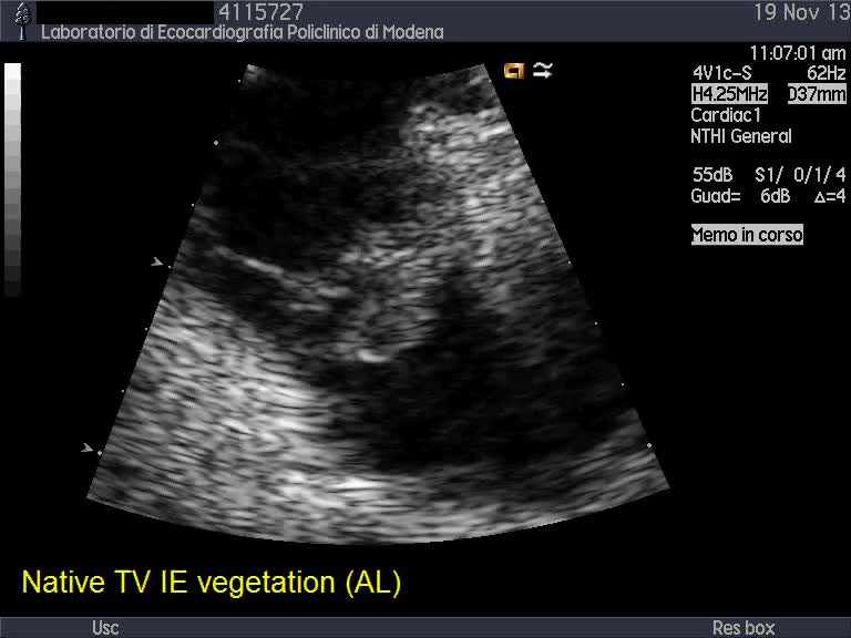 Endocardite infettiva della valvola tricuspide