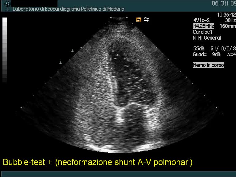 Neoformazione di shunt artero-venosi polmonari