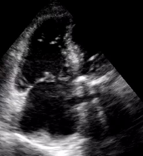 Infarto ventricolare dx