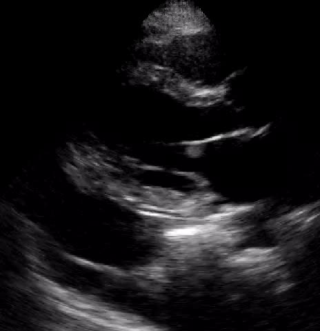 Versamento pleurico e pericardico in corso di pleuropericardite acuta