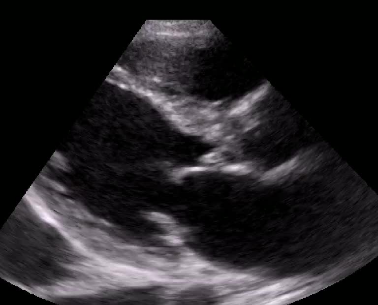 Endocadite su valvola aortica e mitralica in corso di sepsi