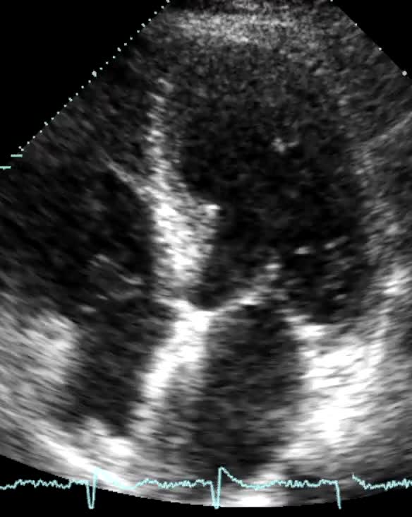 Ostruzione dinamica dell’efflusso vsx