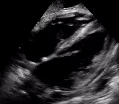 Endocardite su valvola tricuspide in corso di sepsi