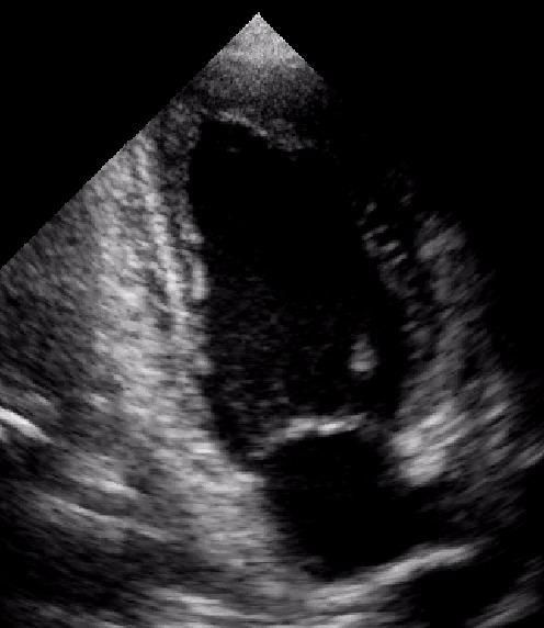 La diagnosi di Tako-Tsubo o Apical Balloning. La cardiomiopatia da stress