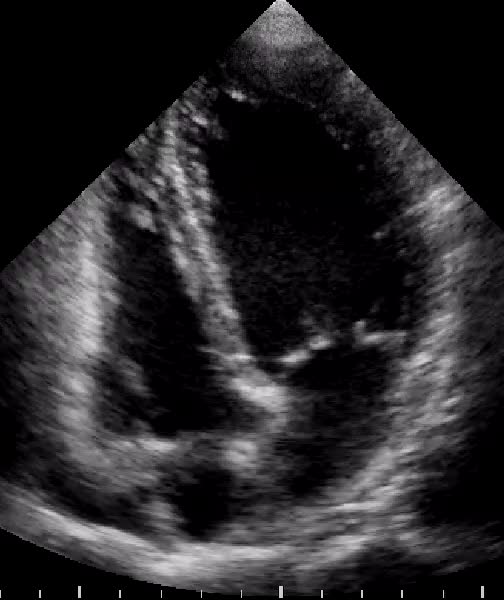 La diagnosi di Tako-Tsubo o Apical Balloning. La cardiomiopatia da stress