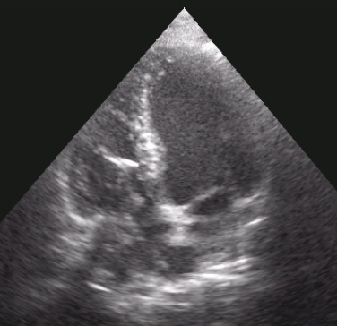 Trombosi su catetere stimolatore in Adx e Vdx