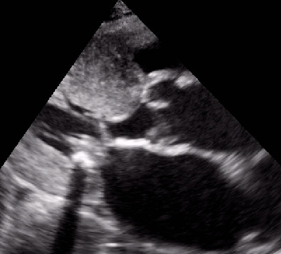 Cardiomiopatia ipertrofica ostruttiva