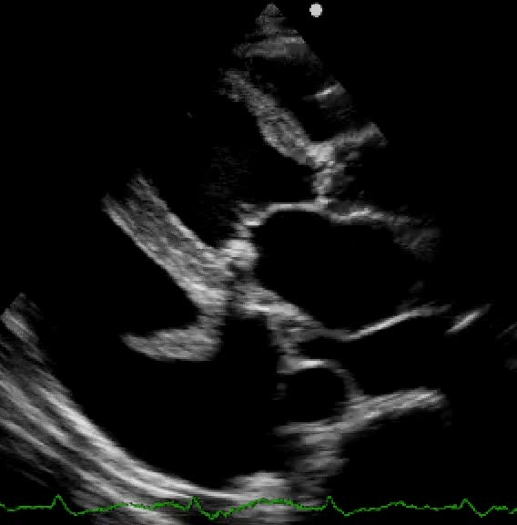 Amiloidosi cardiaca in corso di amiloidosi sistemica