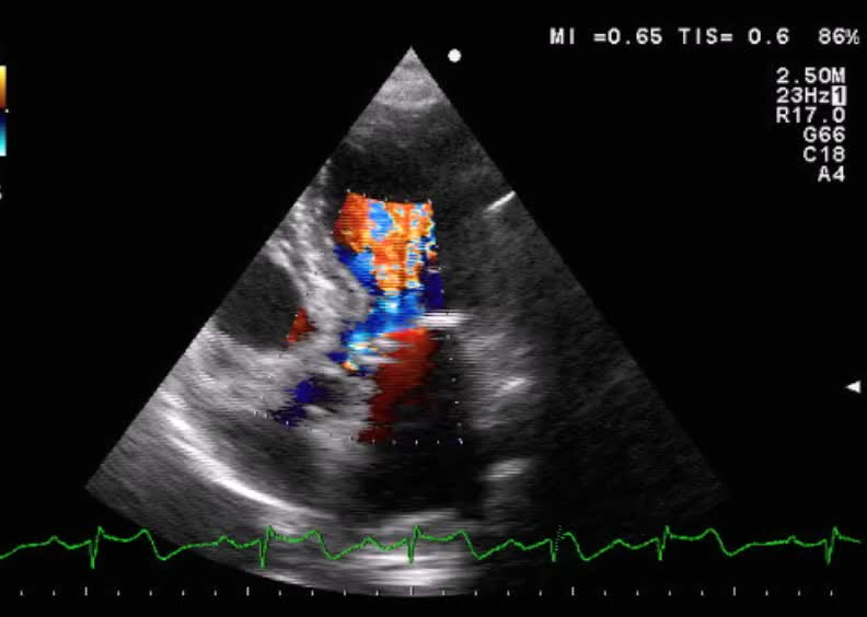 Ostruzione dinamica dell’efflusso VSx