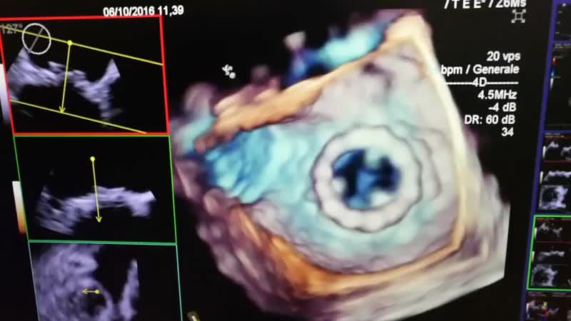 Transseptal mitral Valve in Valve