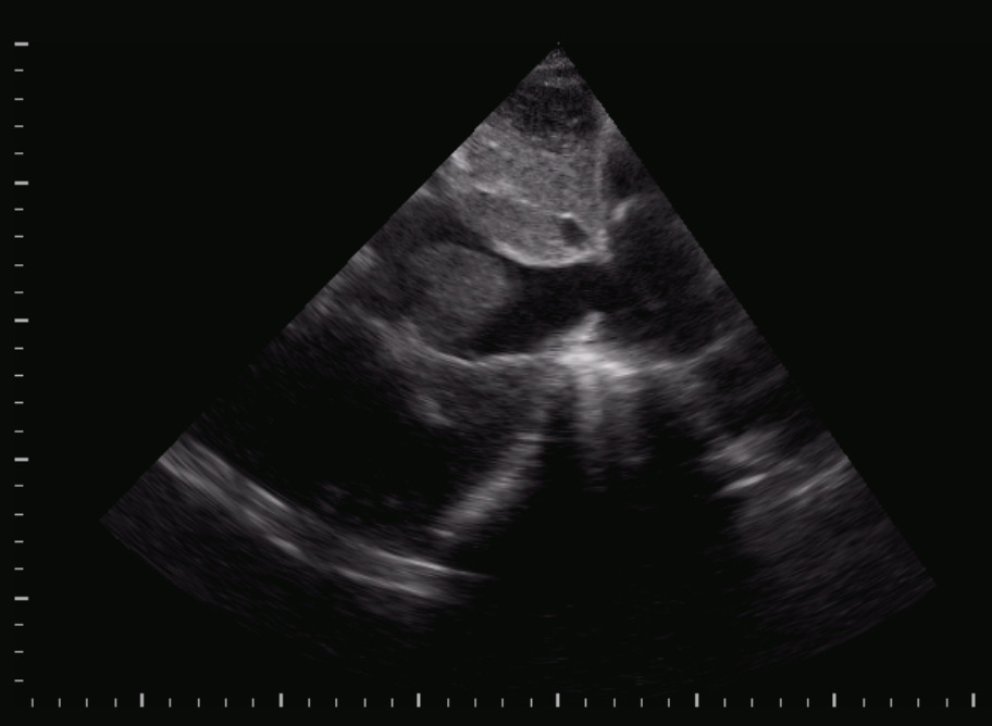 Trombosi della vena cava inferiore in embolia polmonare