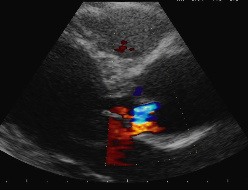Insufficienza aortica in aorta bicuspide