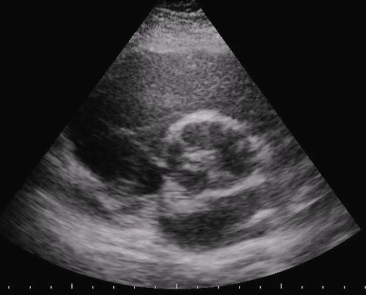 Insufficienza aortica in aorta bicuspide