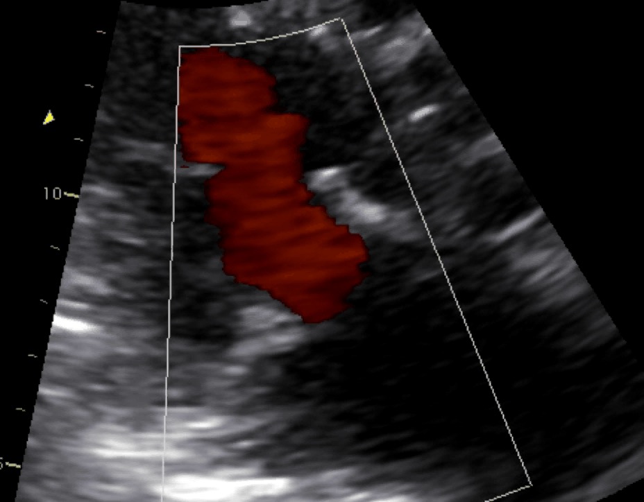 Protesi mitralica normofunzionante