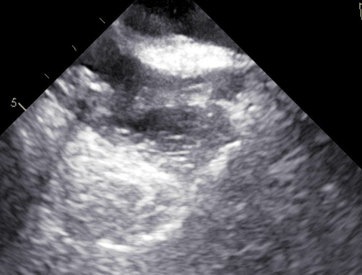 Catetere stimolatore con trombi adesi