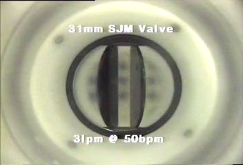 Protesi ad emidischi