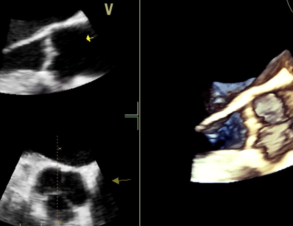Valvola aortica normale