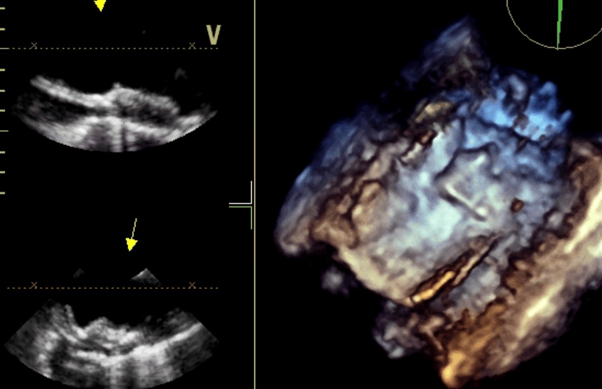 Aorta con placca ulcerata